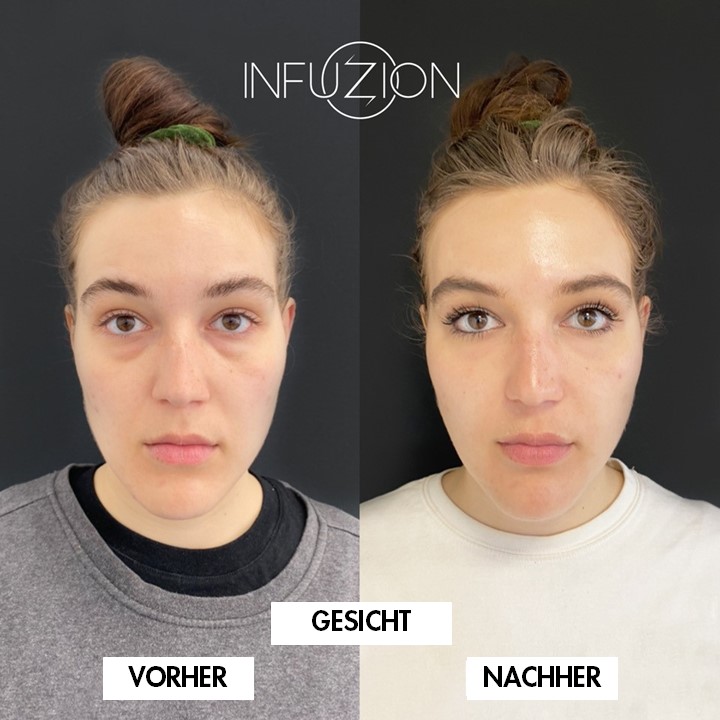 INFUZION® Herstellerbeispiel 1: Gesicht vor und nach der Anwendung